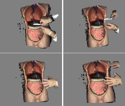 3D recorded surgery demo